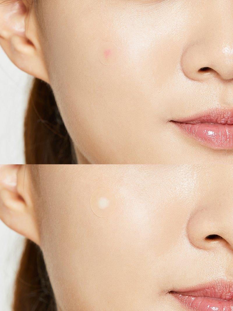 Acne Pimple Master Patch (7286110453807)